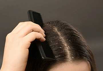 3 Effective Methods for Managing Dandruff